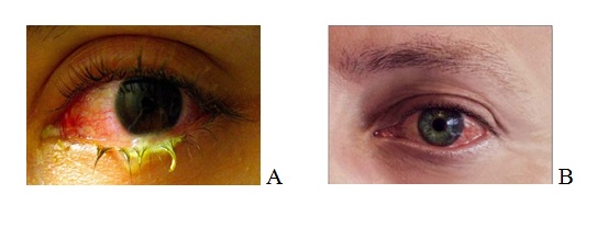 Conjunctivita, cea mai comună infecţie oculară